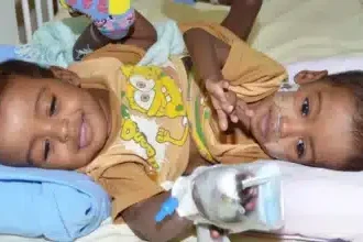 عملية فصل توأم سيامي في ود مدني تحقق المعجزة الطبية في السودان